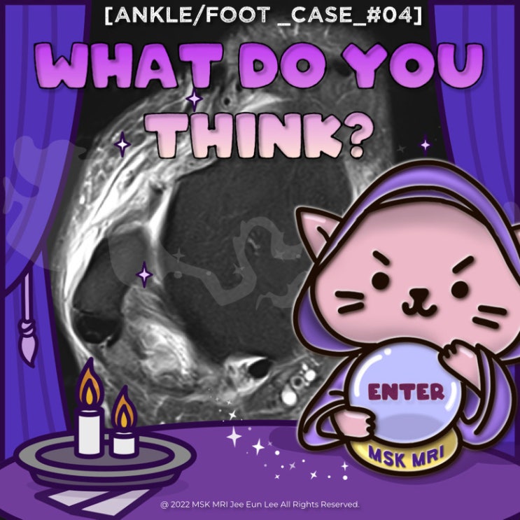  [Ankle/foot_Case_#05] [Easy level] Normal anatomy and ATFL complete tear, CFL partial tear