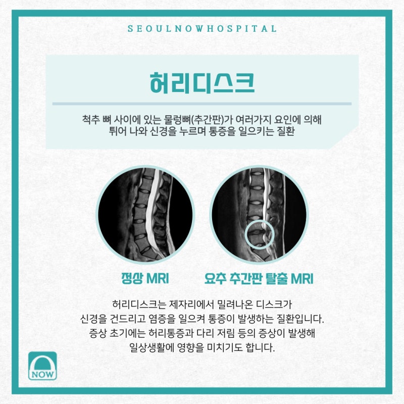 추간판탈출증, 척추병원에서는 허리통증치료 어떻게? 7