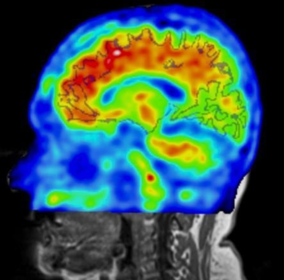  알츠하이머 걸린 뇌 청소하는건 운동 포항이동다이어트