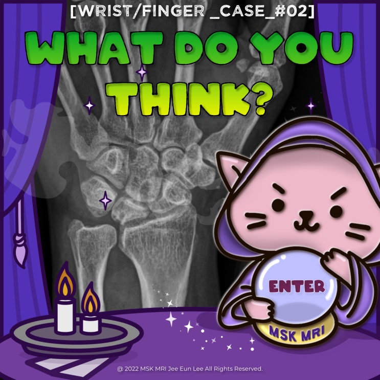  [Wrist/Finger_Case_#02] Kienböck's disease