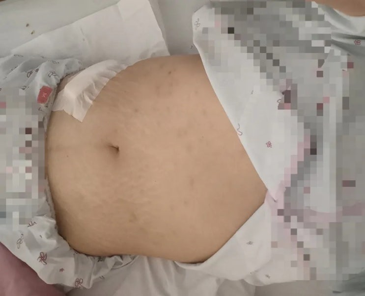 [난소암 4기] 전원 결정