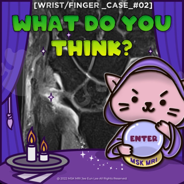  [Wrist/Finger_Case_#03] Palmer classification IB3. Complete avulsion, TFCC tear, anatomy