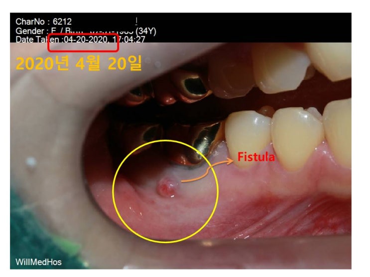  잇몸에 생긴 고름주머니 신경치료로 해결!
