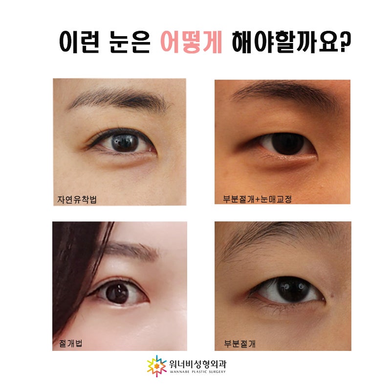 외눈교정 자연유착1개월 후 리얼리뷰 / 쌍꺼풀이 있어 사라진 사람의 쌍수후기 / 눈성형, 쌍꺼풀수술비용, 자연유착고통, 쌍꺼풀매몰