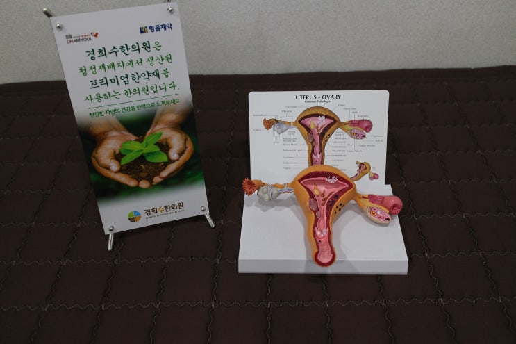  자궁근종의 원인, 증상, 진단, 수술, 한약 치료