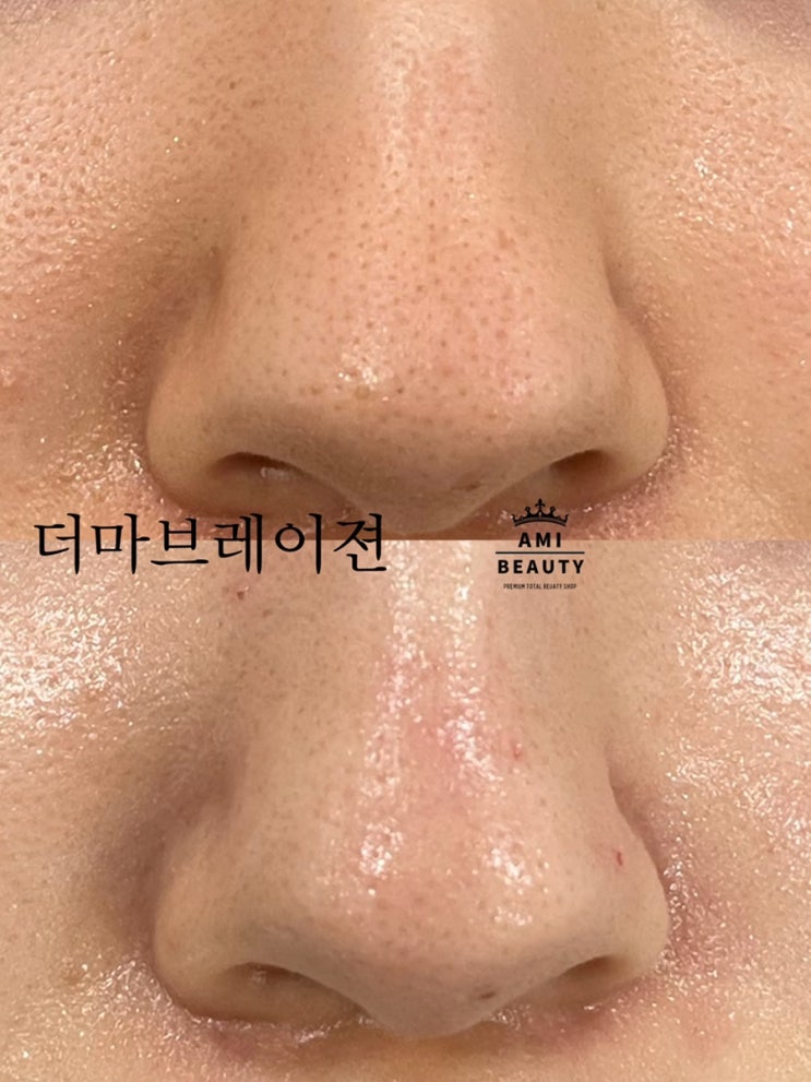  더마브레이젼으로 블랙헤드 코모공 수축.물광피부 완성 (대구아미뷰티)