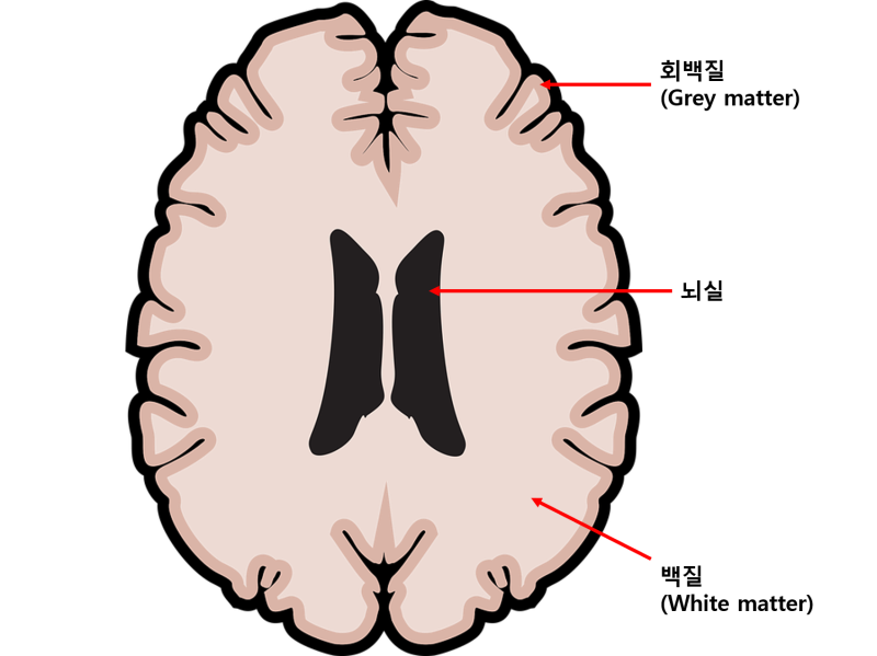 뇌실주위 백질연화증(Periventricular leukomalacia),증상 및 재활치료 관련 정보 글. : 네이버 블로그