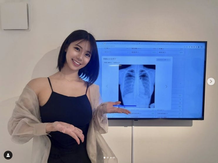 가슴 성형 의혹에 정면으로 맞선 스즈키 후미나, 'I컵 가슴' 논란 끊이지 않아 직접 엑스레이 사진 공개해 가슴 성형 의혹에 정면으로 맞선 스즈키 후미나, 'I컵 가슴' 논란 끊이지 않아 직접 엑스레이 사진 공개해