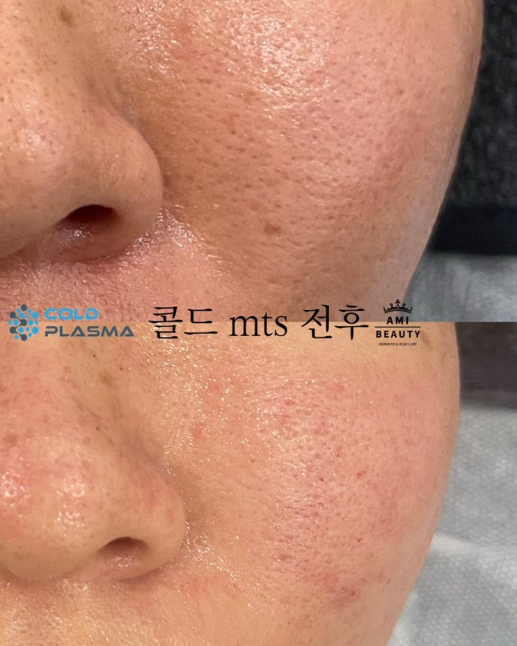  콜드mts플라즈마 모공수축 탄력개선 주름개선 엑소좀과 시너지효과 (70%할인행사) 대구아미뷰티