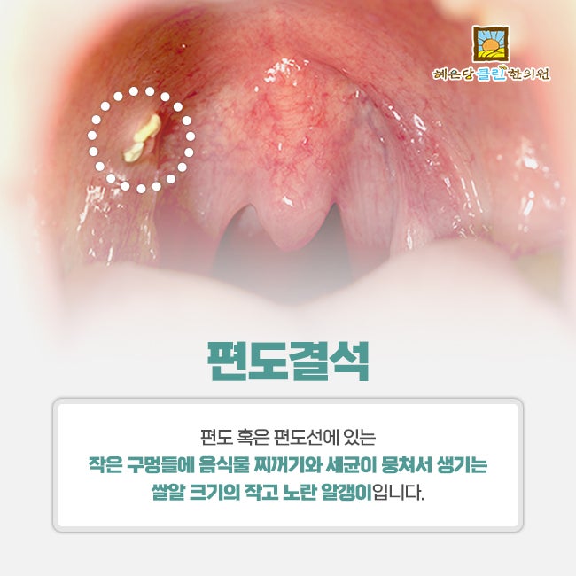 편도결석 냄새를 없애는 치약을 추천합니다