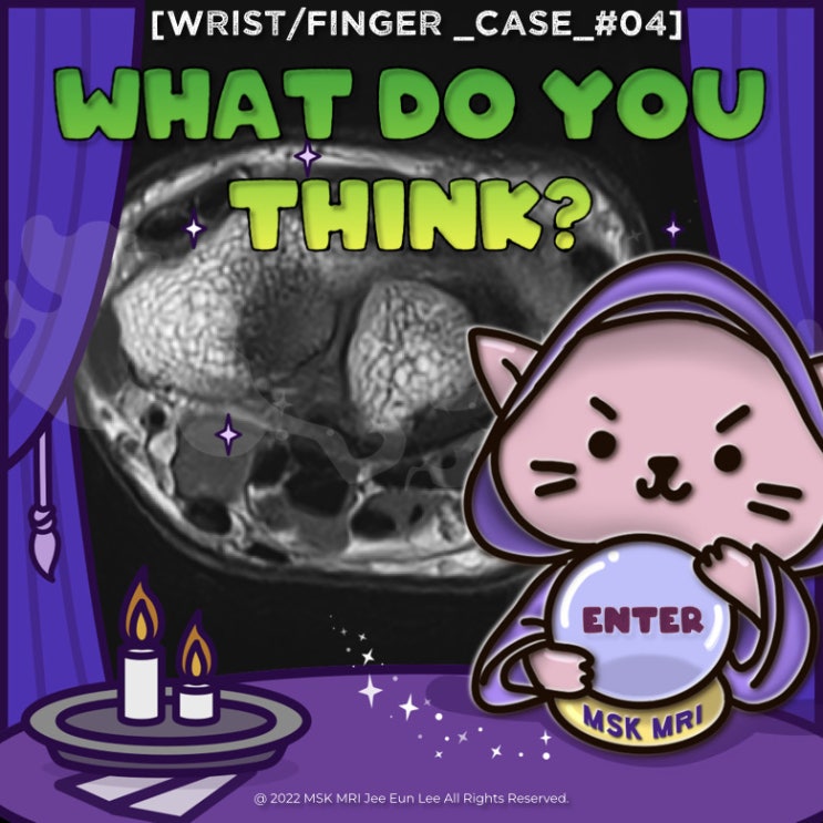  [Wrist/Finger_Case_#04] flexor carpi radialis brevis vel profundus, accessory muscle