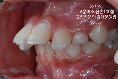  소아교정, 성장기 교정, 앞니돌출, 과개교합 2급부정교합치료 고운미소신촌1호점