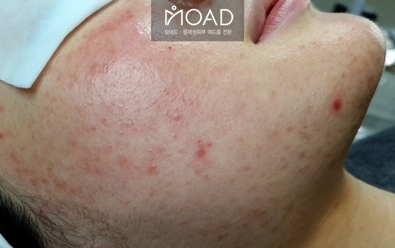 모낭염 증상부터 여드름까지 해결