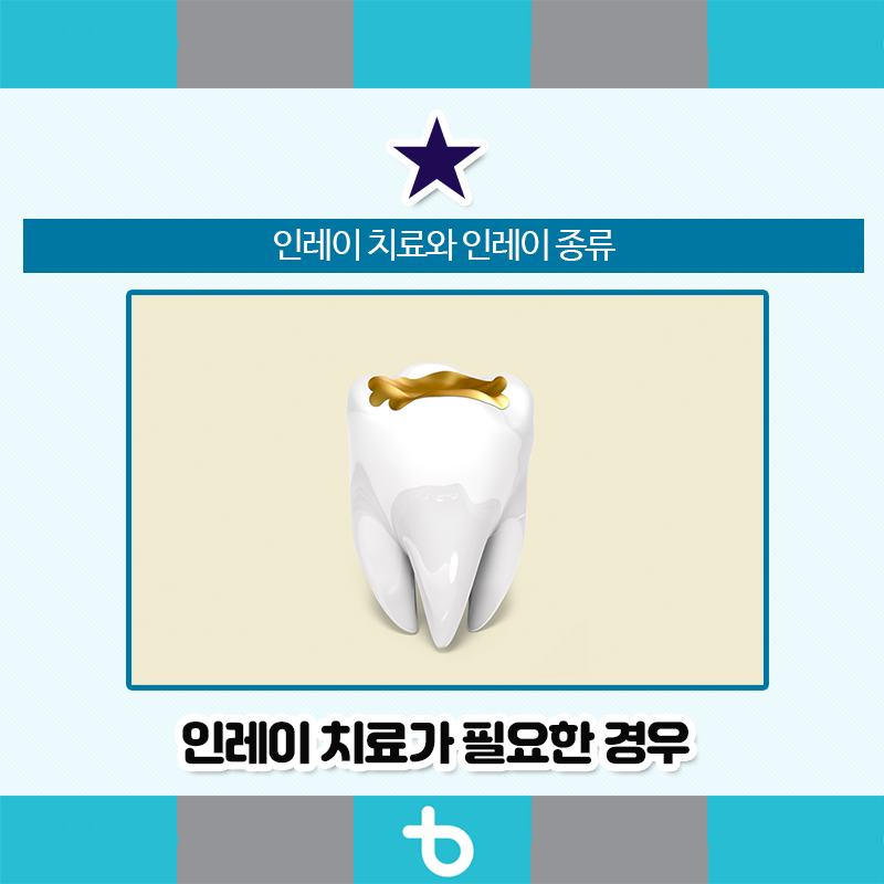 온센동치과의원, 인레이 치료와 인레이의 종류