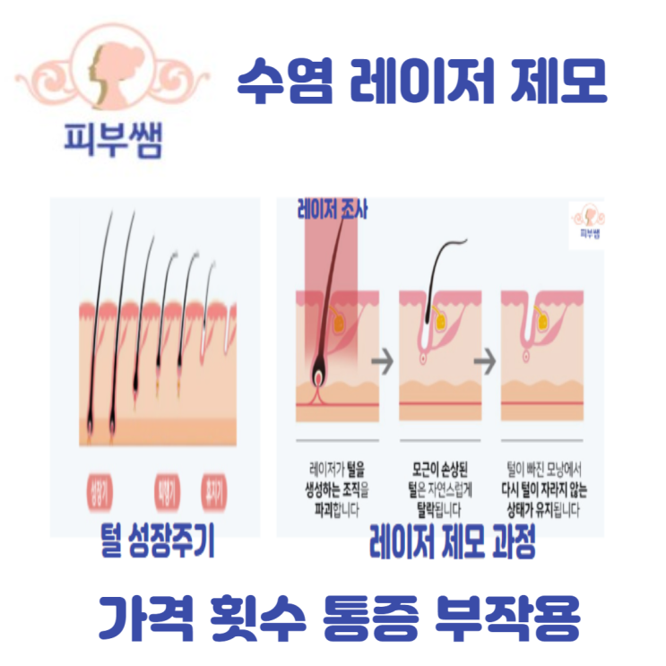 수염 레이저 제모 가격 횟수 통증 부작용