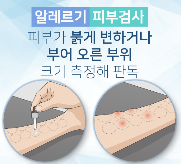  알레르기 비염 (Allergic rhinitis) (3) - 진단방법 : 피부단자검사(Skin prick test), 피내검사(Intradermal test), 유발검사