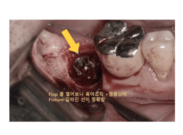  임플란트 찢어짐 깨짐 손상 제거 및 임플란트 재수술 과정