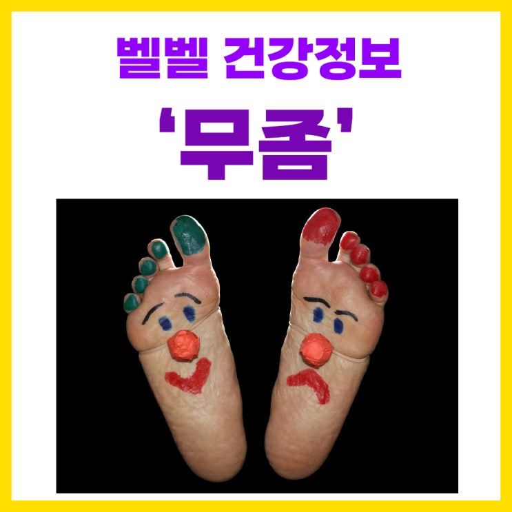  무좀 걸리는 이유 치료 방법 증상 연고 발톱무좀