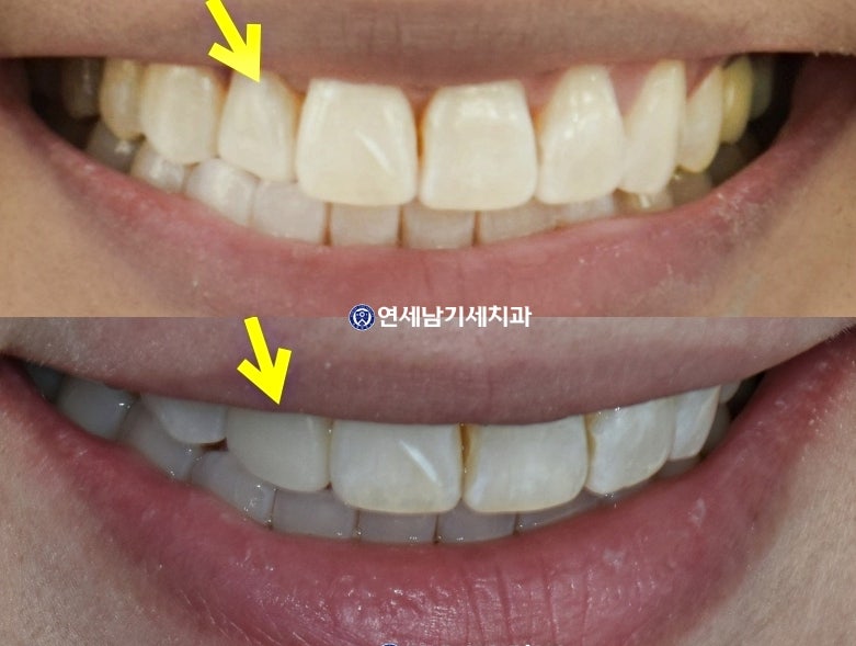 헨리라미네이트 가격 피오연예인 라미네이트 부작용/비용, 하남 미사치과