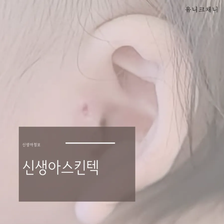  신생아스킨텍  신생아쥐젖 제거시 주의할 점