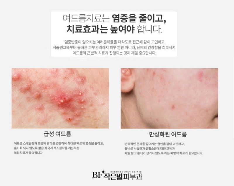 별내피부과 여드름 치료를 잘하는 피부과 여드름 재발시 6