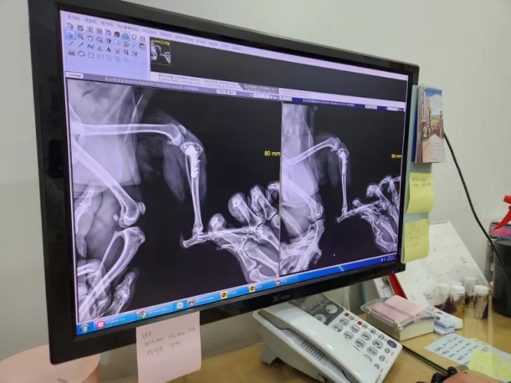 십자인대파열 수술후 한달 십자인대파열 수술후 한달