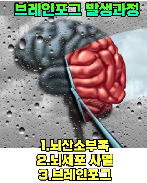 브레인포그(Brain Fog), 머리가 무겁고 어지러움 치료병원 : 네이버 블로그