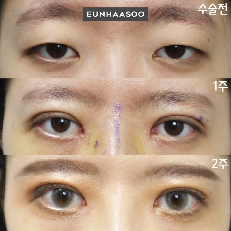안검하수 자연유착+비절개눈매교정과 2