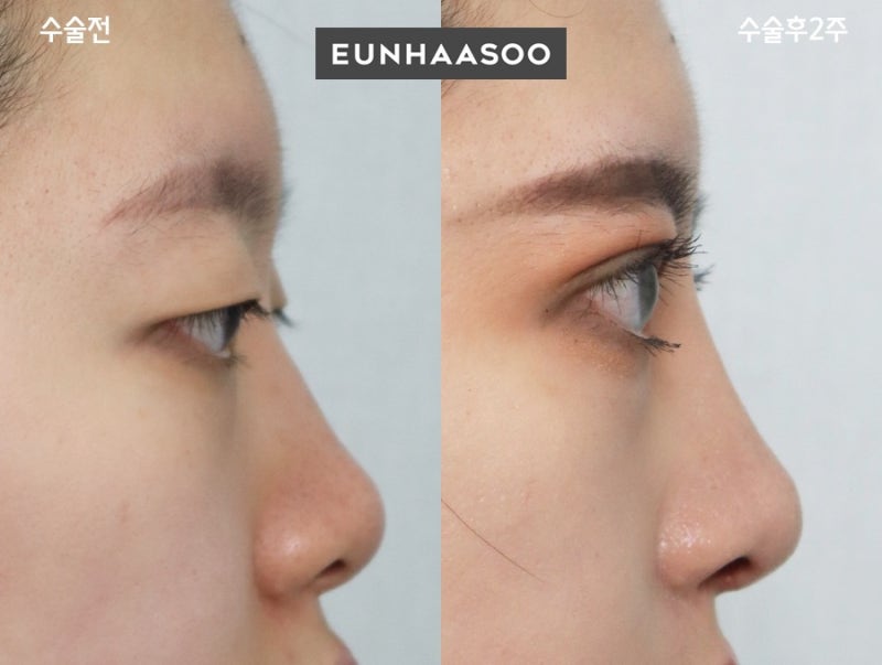 안검하수 자연유착+비절개눈매교정과 1