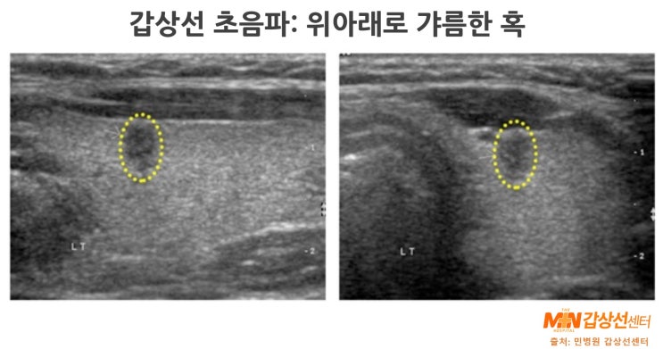 [갑상선은 민병원] 갑상선 초음파에서 보이는 악성(암) 우려 소견 6가지