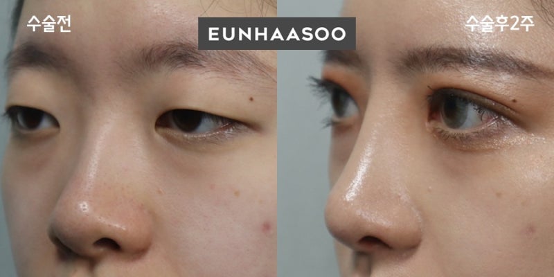안검하수 자연유착+비절개눈매교정과 3