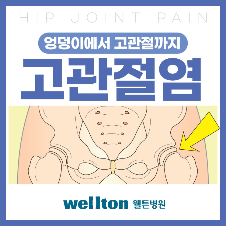 마곡역병원, 엉덩이 통증 자주 느낀다면 고관절염 원인