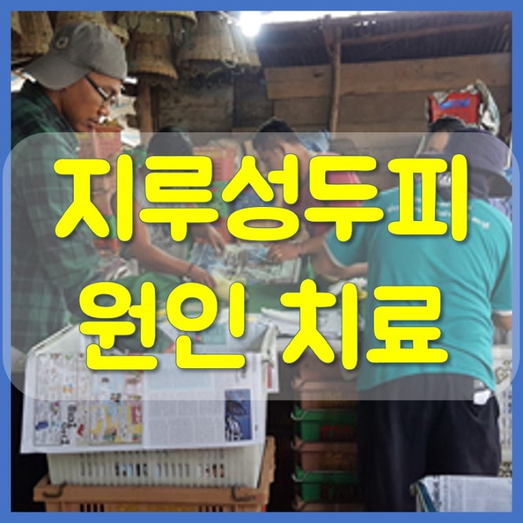  지루성두피염 원인과 치료 방법 따라하세요