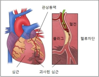  심근경색 환자...퇴원 후 첫 1년 관리 여부에 따라 수명 결정