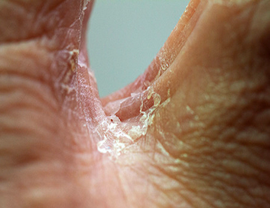 서대문권약국/족무좀약 추천(원인,증상,치료법) 1