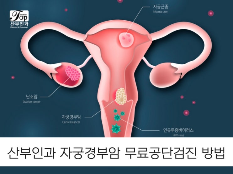 산부인과 자궁경부암 무료공단검진 방법 산부인과 자궁경부암 무료공단검진 방법