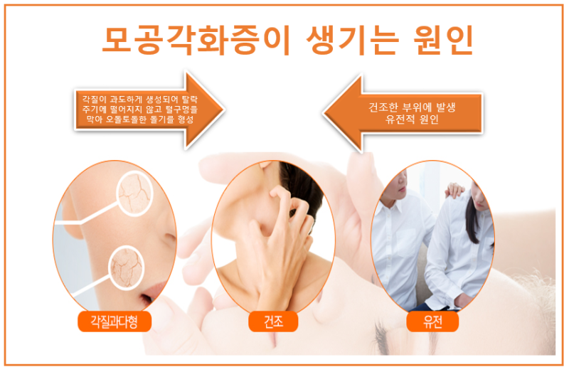 강남 모공강화증치료 닭살피부 화안케어 후기 9