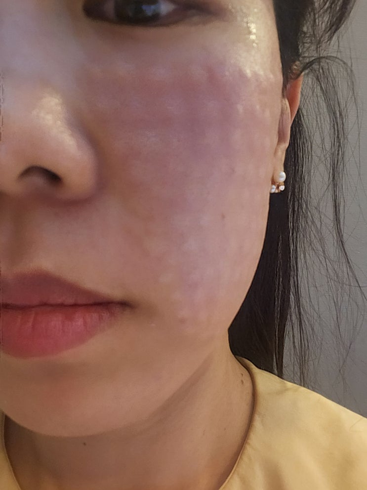 리쥬란힐러 * 리쥬란 손주사 꾸준히 맞은 찐후기
