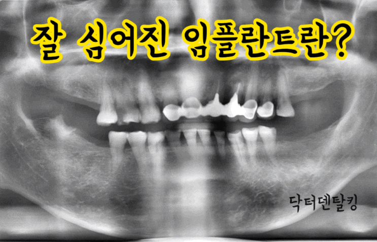  임플란트 잘하는곳 수술방법 / 잘 심어진 임플란트 각도 및 중요한 것은?