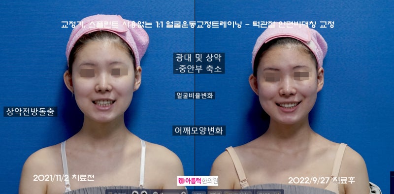 중퇴축소술, 돌출얼굴교정술 - 턱관절면 비대칭교정술