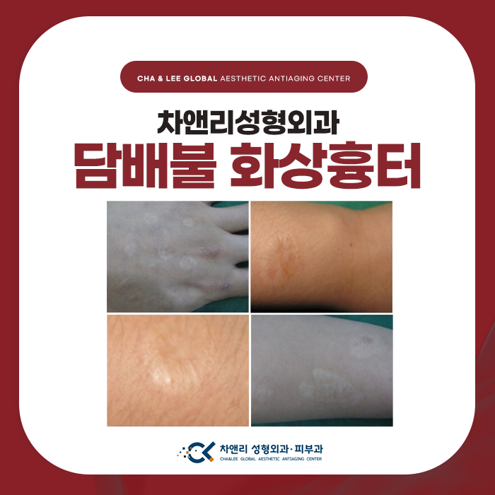  담뱃불 화상흉터 담배빵 가리고 싶다면