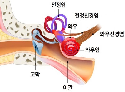 어지럼증 유발 귀질환(전정신경염, 메니에르병, 이석증)의 원인, 증상, 한의원 치료 / 메스꺼움, 귀먹먹, 난청 3