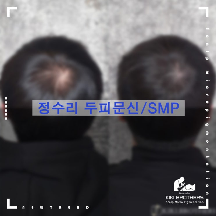  정수리탈모, 얼마든지 커버가능합니다. 두피문신/SMP, 탈모커버 전문점 키키브라더스 노원