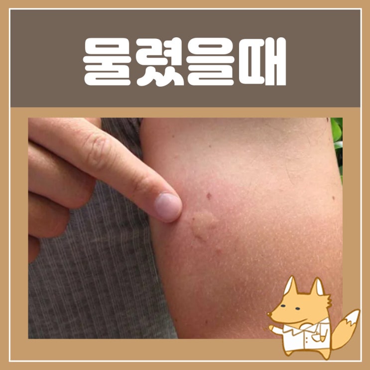  지네 물렸을때 증상 치료 응급처치 : 벌레 지네에 물렸을때