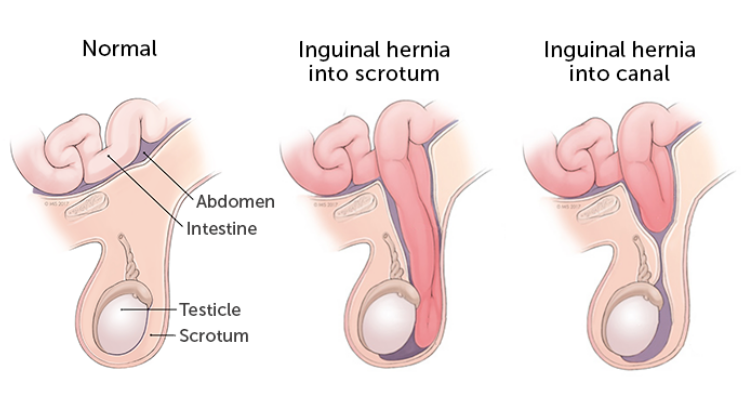  (수술공부)GS:High ligation,herniorrhaphy:inguinal hernia(서혜부 탈장)
