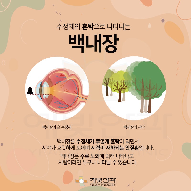 백내장수술후기 뿌연 시야가 고민이라면