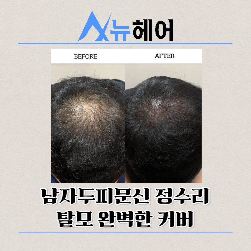 남자두피문신 정수리탈모 완벽한 커버 : 네이버 블로그 남자두피문신 정수리탈모 완벽한 커버 : 네이버 블로그
