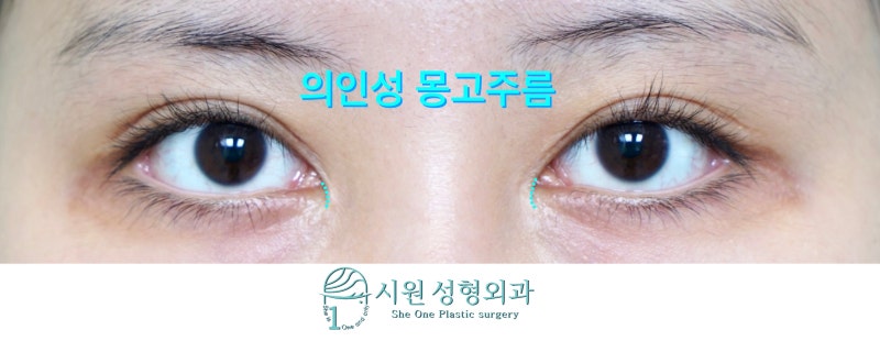 앞트임 복원 수술(앞트임 재건) 6