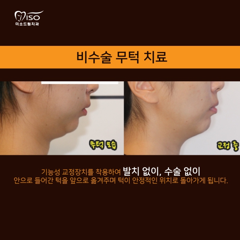 무턱 수술 vs 무턱 교정 이렇게 다릅니다! : 네이버 블로그