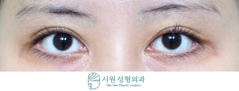 253 후열림복원 (후열림재건) 9일째 (실밥제거직후) 후기:후열림 부작용 (ㄷ자변형, 점막노출, 눈꼬리내림 등) feat. 시원한 성형외과